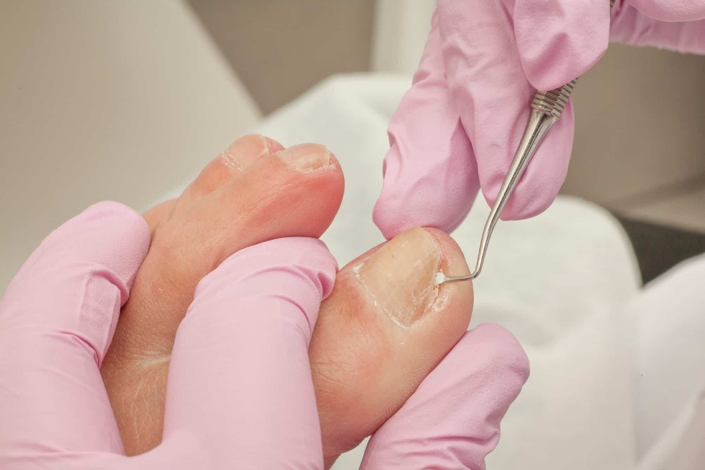 Ingrown toenail treatment at General Foot Care podiatry clinic in Arnold, Nottingham