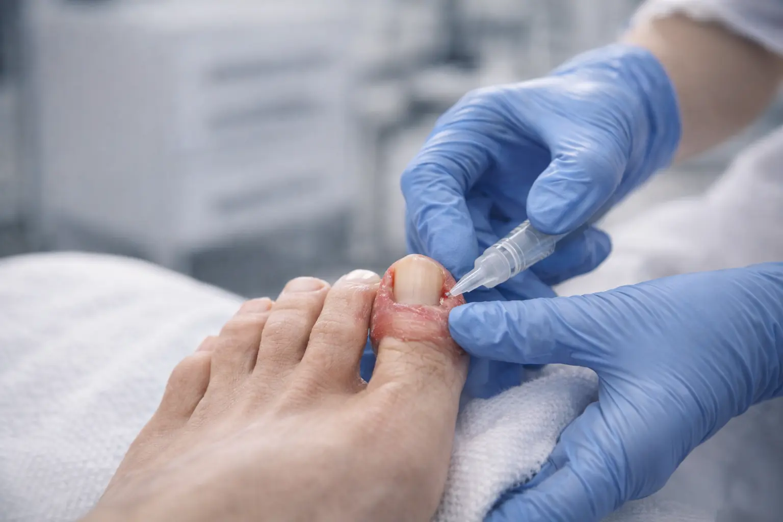 Podiatrist injecting local anaesthetic to treat an ingrown toenail at General Foot Care clinic in Arnold