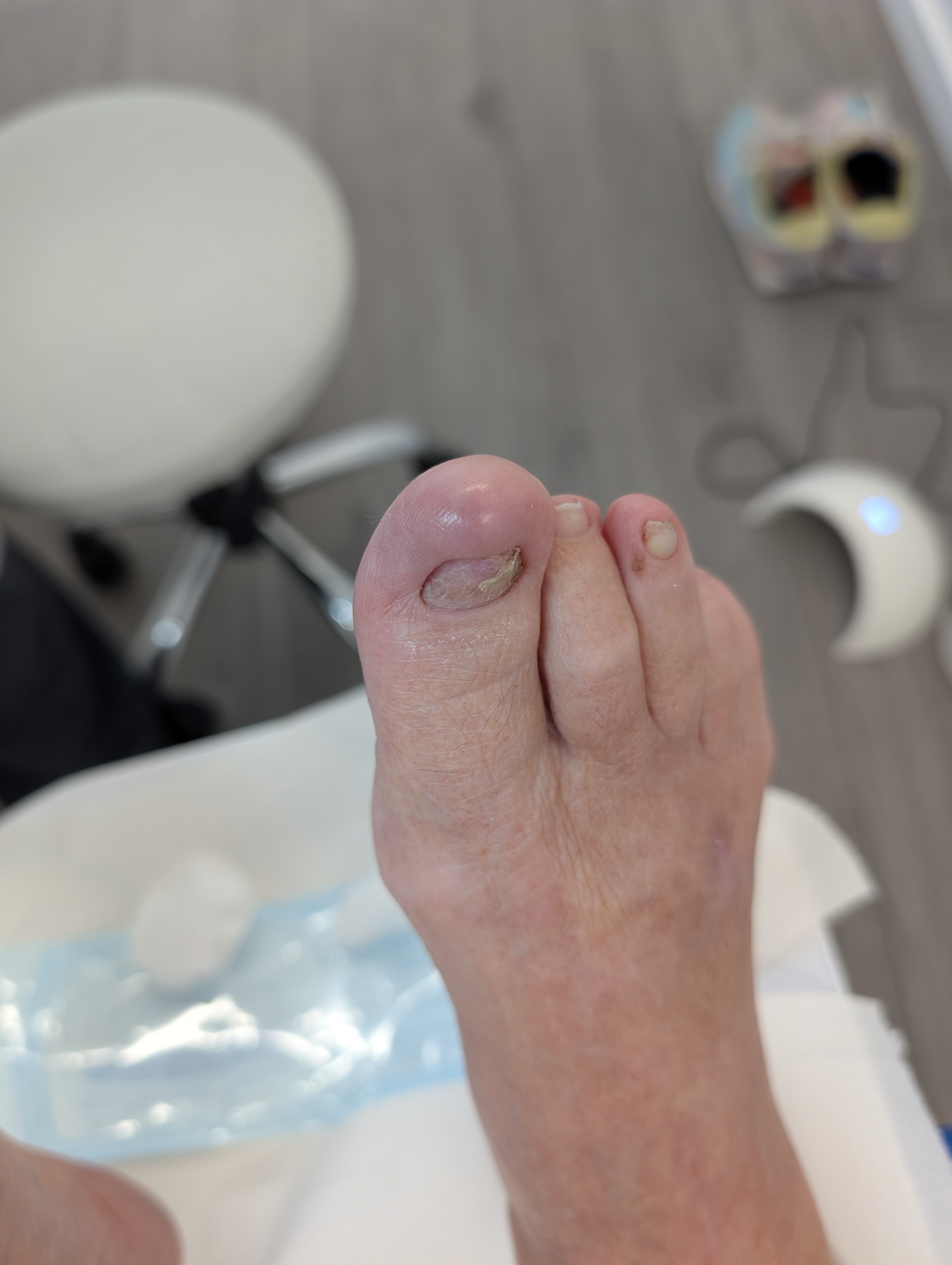 The same toenail before reconstruction, showing a short, uneven nail surface
